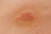 infekcje grzybicze skóry obszary skóry objawy