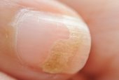 Objawy grzybów paznokciowych